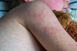 Gejala Campak Anak Sering Disangka Flu Biasa